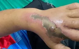 Bé trai bị hoại tử bàn tay nghi do rắn độc cắn