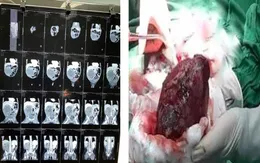 Phẫu thuật u thận ác tính cho bé trai 1 tuổi
