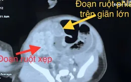 Cứu bé sơ sinh bị teo ruột phức tạp