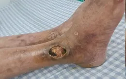 Cứu đôi chân người bệnh thoát khỏi tình trạng hoại tử, nguy cơ phải cắt cụt