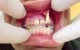 Tỉ lệ biến chứng niềng răng tăng cao, nguyên nhân do đâu?