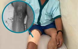 Nguy hại khôn lường khi chữa bệnh bằng "mẹo vặt dân gian"
