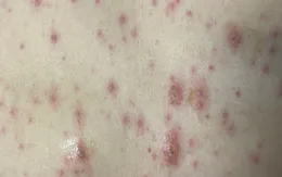 Một huyện ở Hà Nội ghi nhận gần 250 ca mắc thủy đậu