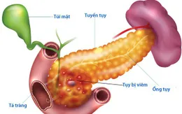 Nguy hiểm bệnh viêm tụy cấp