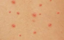 Số ca thủy đậu ở Hà Nội tăng