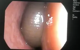 Chảy máu mũi suốt 3 tháng vì đỉa ký sinh