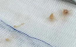 Bé 10 tháng tuổi nguy kịch do hóc xương lươn