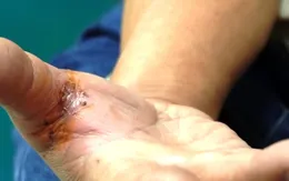 Người dân nên đi tiêm phòng vaccine dại ngay sau khi bị chó cắn, mèo cào
