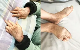 Biến dạng khớp bàn tay, bàn chân do viêm khớp dạng thấp