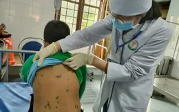 Bắc Kạn: Phát hiện ổ dịch thủy đậu tại một trường tiểu học
