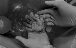Nối bàn tay bị đứt lìa do tai nạn cho bé trai 21 tháng tuổi