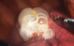 Phẫu thuật lồng ngực nội soi cắt kén khí phổi cứu bệnh nhân tràn khí màng phổi