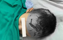 Bị chó nhà tấn công, bé trai 23 tháng tuổi nhập viện với nhiều vết thương vùng đầu, mặt