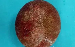 Lấy viên sỏi to như quả trứng trong bàng quang bệnh nhân