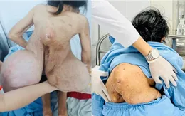 Hai lần phẫu thuật cắt bỏ khối u khổng lồ cho bệnh nhân