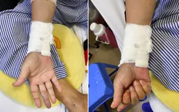 Suýt phải cắt cụt bàn tay do tắc động mạch