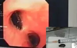 Nhập viện vì khó thở, đau tức ngực, bác sĩ phát hiện "thủ phạm" là hạt hồng xiêm nằm chắn ngang lòng phế quản