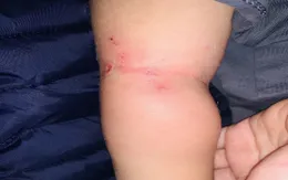Nguy hiểm từ nhiễm trùng da do tụ cầu