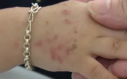 Bệnh tay chân miệng đang vào mùa - Cha mẹ lưu ý để bệnh không trở nặng