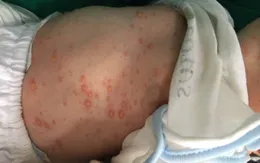 Lây thủy đậu từ mẹ, bé sơ sinh bị biến chứng nặng
