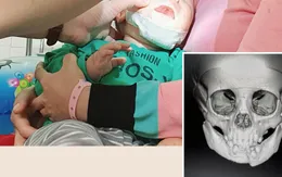 Bé 10 tháng tuổi gãy xương hàm dưới do ngã xe đẩy