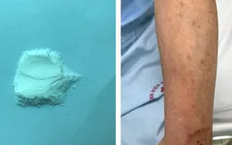 Suy tuyến thượng thận do tự điều trị bệnh bằng thuốc không rõ nguồn gốc tại nhà