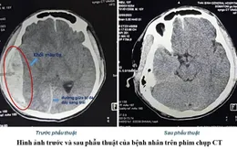 Lãnh đạo bệnh viện ký giấy mổ cứu sống bệnh nhân bị tai nạn giao thông khi không có người nhà
