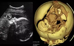 Ca phẫu thuật não đầu tiên trên thai nhi trong bụng mẹ được thực hiện