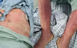 Triển khai các hoạt động điều tra, giám sát, phòng chống bệnh liên cầu lợn trên người