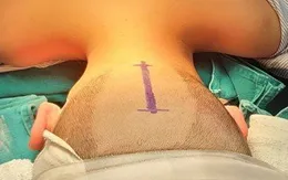 Bé 10 tuổi không đi lại được vì khối u tiểu não