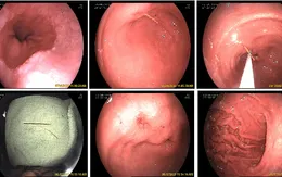 Gắp chiếc tăm dài gần 7cm găm sâu vào dạ dày bệnh nhân