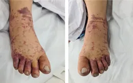 Người phụ nữ nguy kịch do nhiễm liên cầu lợn