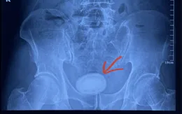 Người đàn ông có viên sỏi kích thước 6cm trong bàng quang