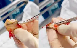 Bất ngờ khi tháo dụng cụ tử cung sau 20 năm