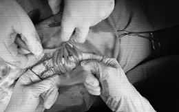 Em bé có 5 vòng dây rốn quấn cổ "hiếm gặp" chào đời an toàn