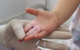 Đắk Lắk: Một bệnh nhi tử vong vì tay chân miệng