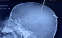 Phẫu thuật kịp thời cho bé trai bị cây đinh dài 3cm đâm qua xương sọ