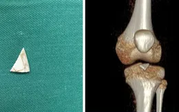 Lấy mảnh sành sắc nhọn bị "bỏ quên" 2 năm trong khớp gối bé 9 tuổi