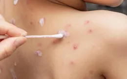 Khuyến cáo phòng bệnh thủy đậu