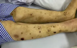Mời thầy lang dùng ong châm trị đau chân tay, bệnh nhân đái tháo đường phải nhập viện vì đa biến chứng