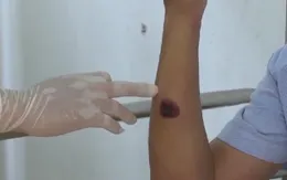 Khẩn trương kiểm soát, không để dịch bệnh than lây lan trên diện rộng