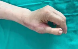Tạo hình ngón tay cái từ ngón chân cho bệnh nhân bị tai nạn lao động