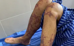 Người đàn ông nguy kịch do nhiễm liên cầu lợn từ thói quen ăn tiết canh