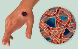 Bộ Y tế: Tăng cường công tác phòng, chống dịch bệnh than trên người