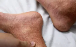 Sốt xuất huyết: Triệu chứng và cách phòng bệnh