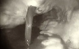 Cảnh báo tình trạng xuất huyết tiêu hóa do dùng nhiều bia rượu