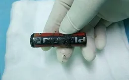 Cọ xát pin vào nhau, bé trai bị pin nổ phải nhập viện
