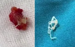 Phát hiện ca bệnh giun chỉ ký sinh tại Phú Thọ