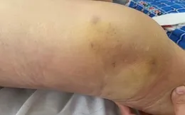 Nguy hại từ việc tiêm khớp không an toàn