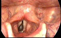 Gắp con đỉa to bằng ngón tay sống trong cổ họng nam bệnh nhân